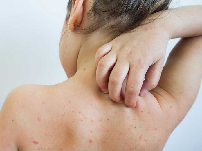 measles